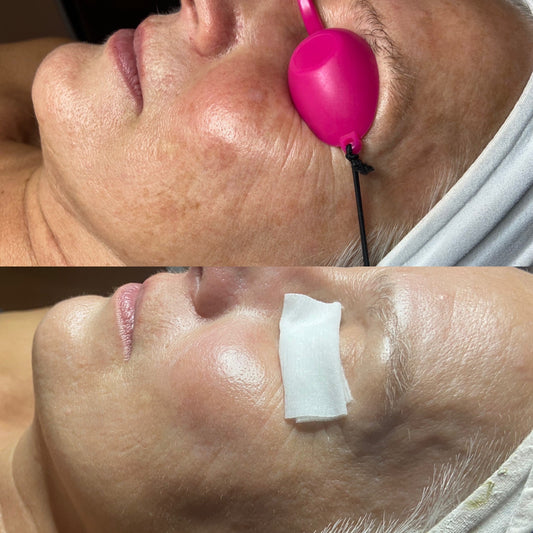 Photorajeunissement — soin lumière pulsée anti-âge au Spa Santé Le Nénuphar